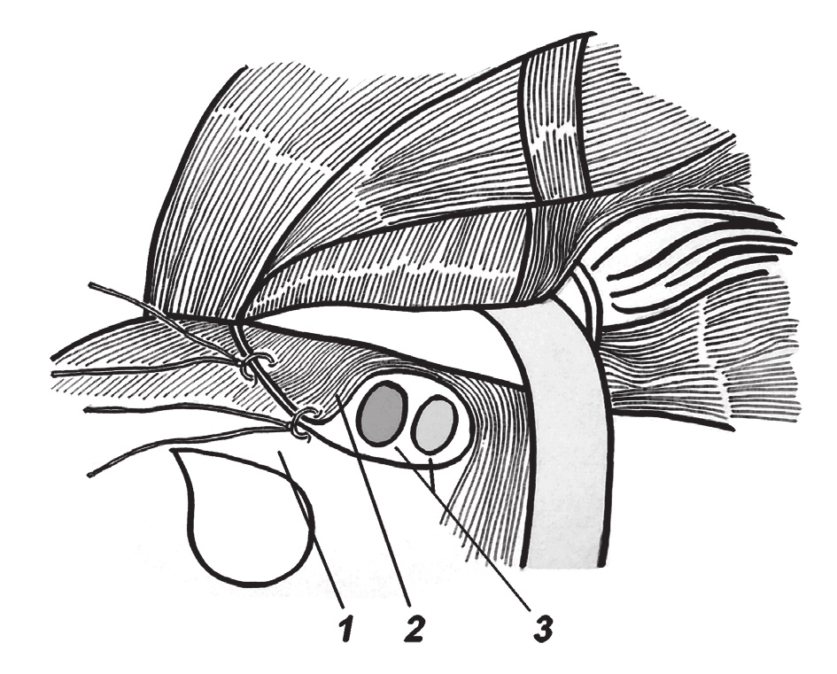 Przednią ścianę kanału pachwinowego otwierano na całej długości szczeliny międzyodnogowej, obie odnogi odpreparowywano na tępo od zawartości kanału pachwinowego, z dokładnym uwidocznieniem nerwu