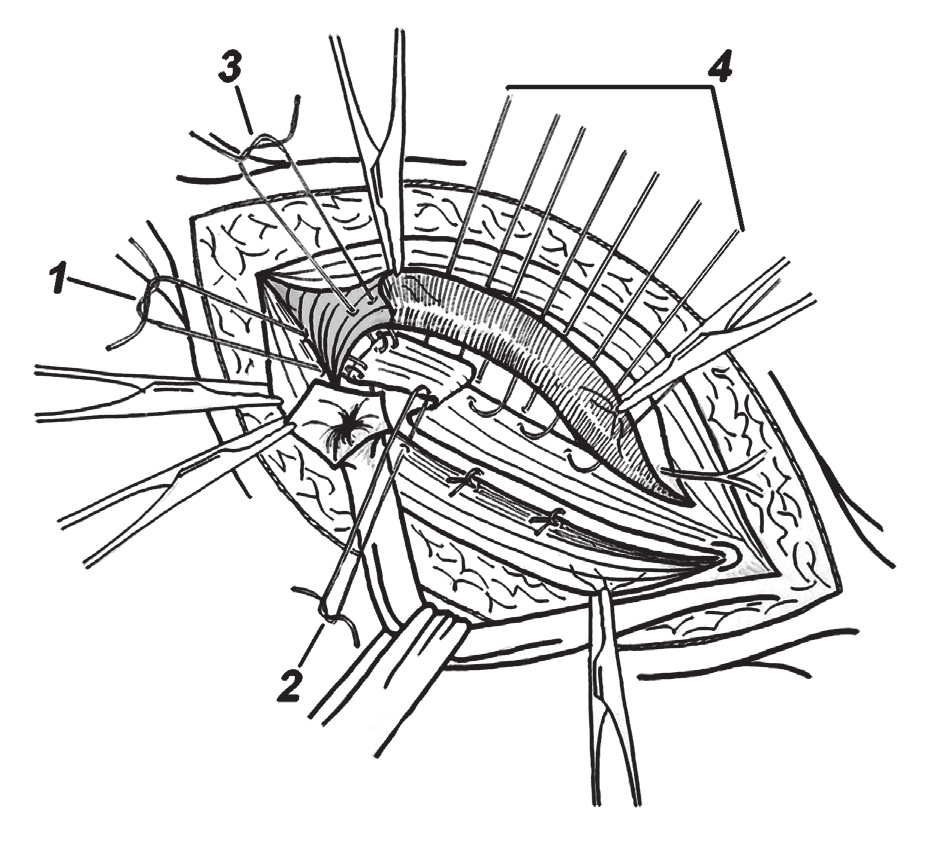 Napinając odnogę, około 3 4 cm powyżej pierścienia pachwinowego głębokiego, nacinano jej włókna skośnie, a następnie w stronę mięśnia prostego brzucha, przechodząc nacięciem przez otwór dla nerwu