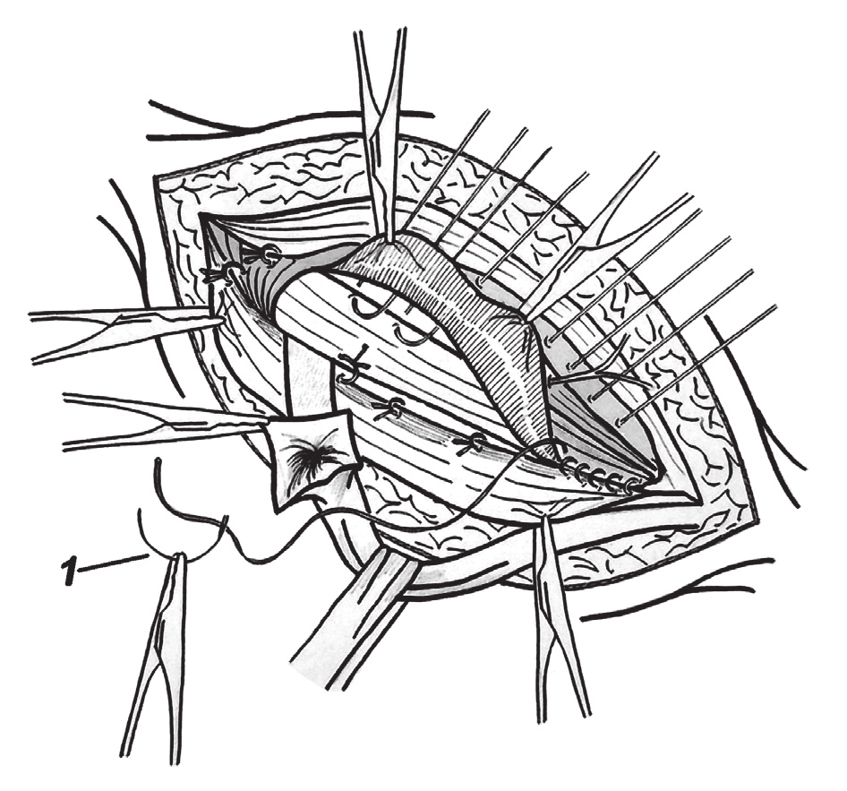 Roman Kuśnierczyk, Adam Wójcik Results of surgical treatment of large scrotal hernias Polish Surgery 2005, 7, 1 wa do ścięgna łączącego i rozcięgna wspólnego szwami materacowymi, które pierwotnie