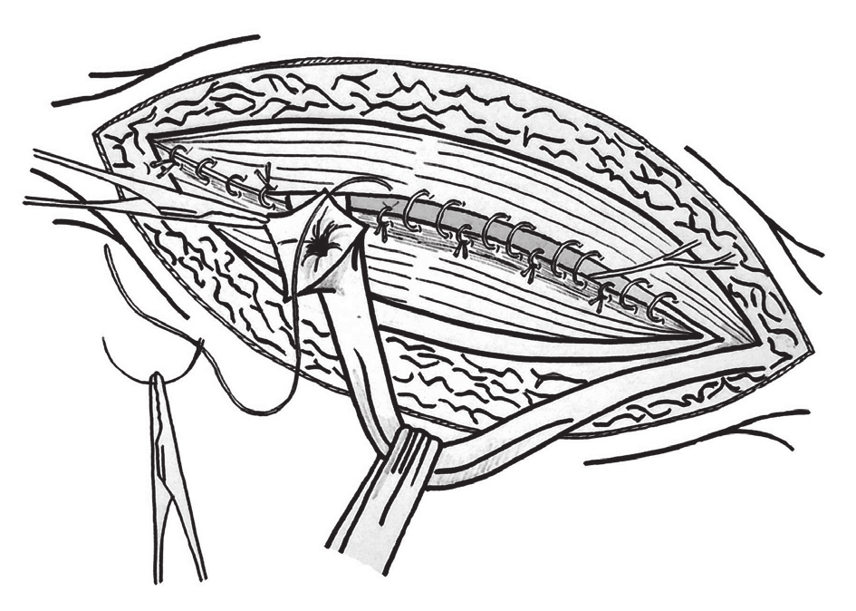 Suturing of the branches of the aponeurosis of the abdominal oblique external muscle below and above the deep inguinal ring Rycina 9.