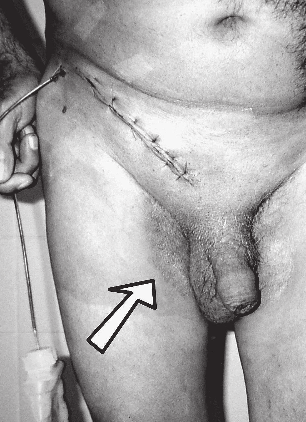 K., aged 68, before (A) and 24h after the operation (B) stosowania szwów wchłanialnych; dodatkowo w przebiegu pooperacyjnym wystąpiły powikłania zapalne, które zawsze, niezależnie od rodzaju techniki