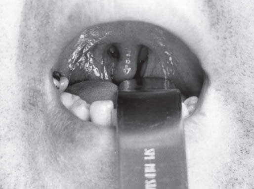 66 Otorynolaryngologia, 2005, 4(2), 65-70 Tracheostomia Z za³o enia leczenie operacyjne OBPS jest metod¹ przyczynow¹ i opiera siê na korekcie ww. nieprawid³owoœci.