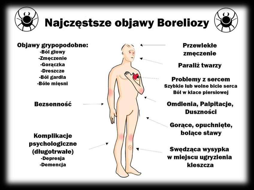 23 1.6. CHOROBY PRZENOSZONE PRZEZ WEKTORY I INNE CHOROBY ODZWIERZĘCE 1.6.1. Borelioza Borelioza jest chorobą zakaźną wywołaną przez krętki z rodzaju Borrelia przenoszone przez kleszcze.