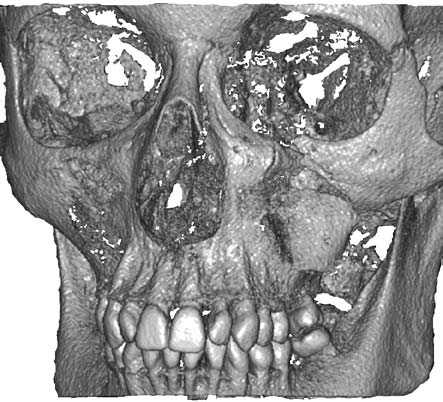 240 B. Szczodry et al. eyeball movement and double vision were also reported. The patient also complained about lack of sense of touch in the area of upper lip and left side of the nose.