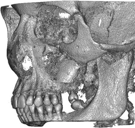 Based on tomography performed (Figs. 1, 2), the following were reported: fracture with dislocation of zygomatic branch.