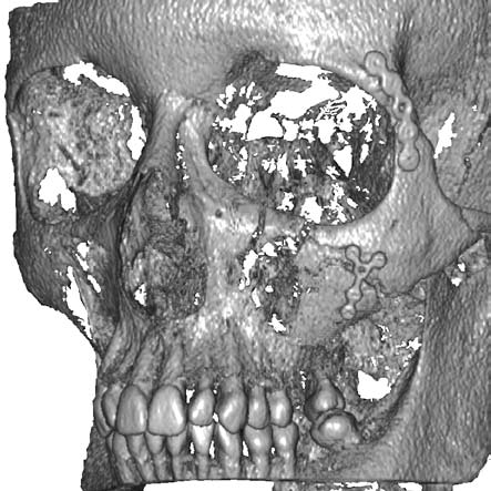 Based on the information gathered, surgery was planned and miniplate osteosynthesis was done as a result all the bone fractions were arranged correctly.