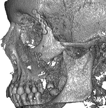 Cone-beam reconstruction showing the fracture of the left zygoma bone with displaced of zygomatic branch, fracture of orbital floor, maxillary multiple fracture Ryc. 1.