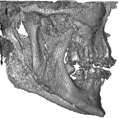 CBCT in Maxillofacial Surgery 241 Case 2 Bilateral Condylar Fracture A patient, aged 35, had an injury as a result of hit at chin.
