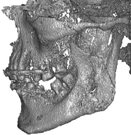 Palpable examination: ache in the area of temporo-mandibular joints, with a tendency to intensify during movements and limited movement of head of condylar process while moving the lower jaw.