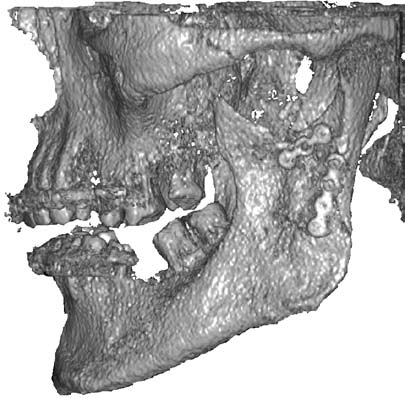 The patient was referred to computed tomography with cone-shaped radiation, which proved that the initial diagnosis was correct and clearly showed the direction of fractures of condylar processes.