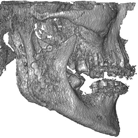 Stable miniplate osteosynthesis of condylar process of mandible on both sides was done in order to stabilize the bone fractions.