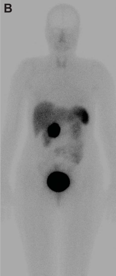 Widoczny ogniskowy wychwyt radioizotopów w głowie trzustki Fig. 1. Coronal of positron emission tomography/computed tomography (A) and somatostatine receptor scintigraphy (B) imaging.