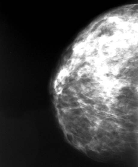 Ryc. 1. Mammogram obrazujący typ N1 nasilenia gęstości mammograficznej wg klasyfikacji Wolfego Ryc. 2.