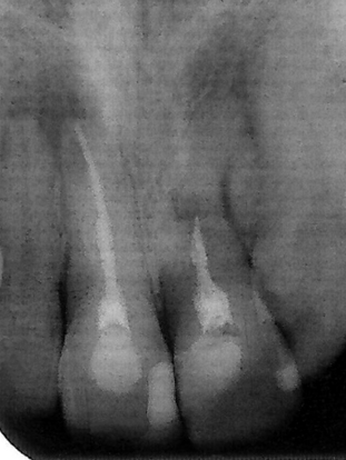 Zdjęcie rtg zęba 11 po wypełnieniu światła kanału Figure 2.