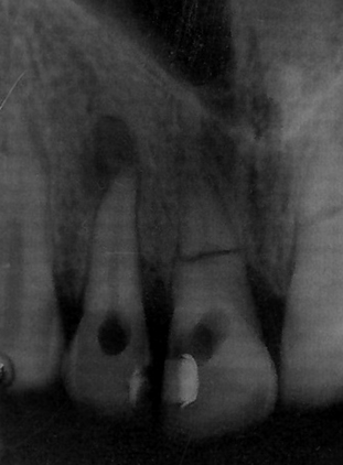 Odległe leczenie endodontyczne zębów stałych u osób dorosłych po złamaniu poprzecznym