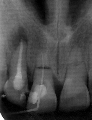 Zdjęcie rtg przedstawiające ząb 12 po ostatecznym wypełnienie kanału Figure 6.