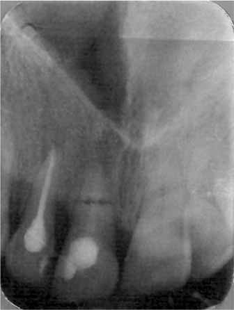 Rycina 9. Zdjęcie wykonane po 15 miesiącach od zakończenia leczenia Figure 9. X-ray photo taken after 15 months from the end of treatment U pacjenta J.K.