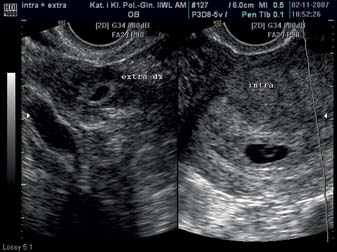 Heterotopic pregnancy. A case report Ryc. 1.