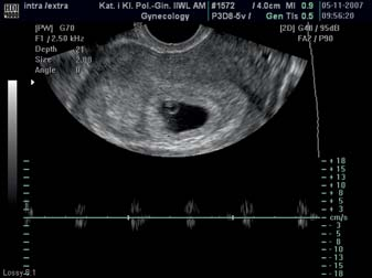 Ultrasound image of intrauterine and extrauterine pregnancy located in the right oviduct kontrolne β HCG 27 393 miu/ml, w badaniu USG stwierdzono w jamie macicy pęcherzyk ciążowy zawierający