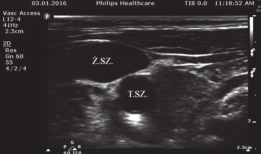 Zastosowanie ultrasonografii pozwala na kontrolę położenia igły w czasie rzeczywistym. Wiązka ultradźwięków ma grubość około 1 mm i szerokość zależną od wymiarów czoła głowicy.