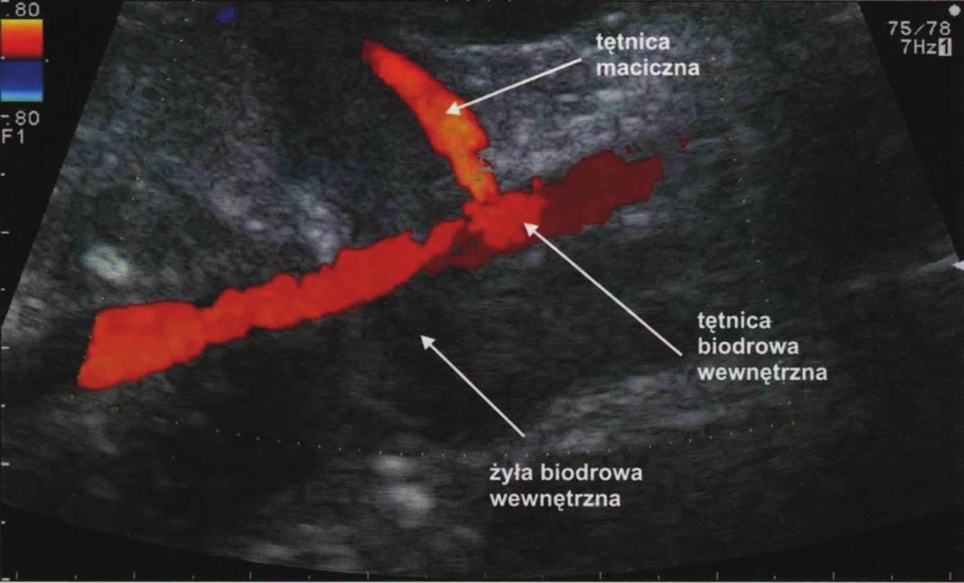 Rycina 5. Uwidocznienie skrzyżowania tętnicy macicznej prawej z naczyniami biodrowymi w badaniu dopplerowskim [152]. Rycina 6.
