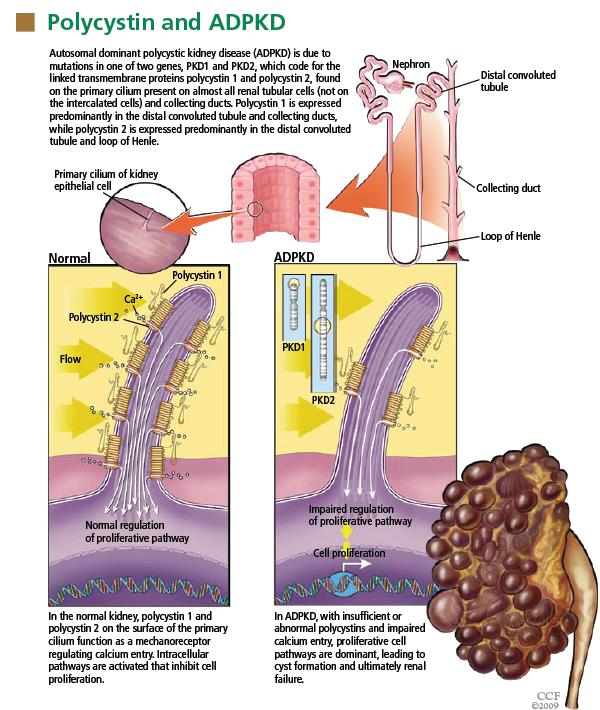 Autosomalna dominująca torbielowatość nerek Zamiana jednej z zasad powoduje, że policystyna zmienia właściwości fizykochemiczne Efekt: - defekt budowy błony podstawnej cewek i pozakomórkowej macierzy