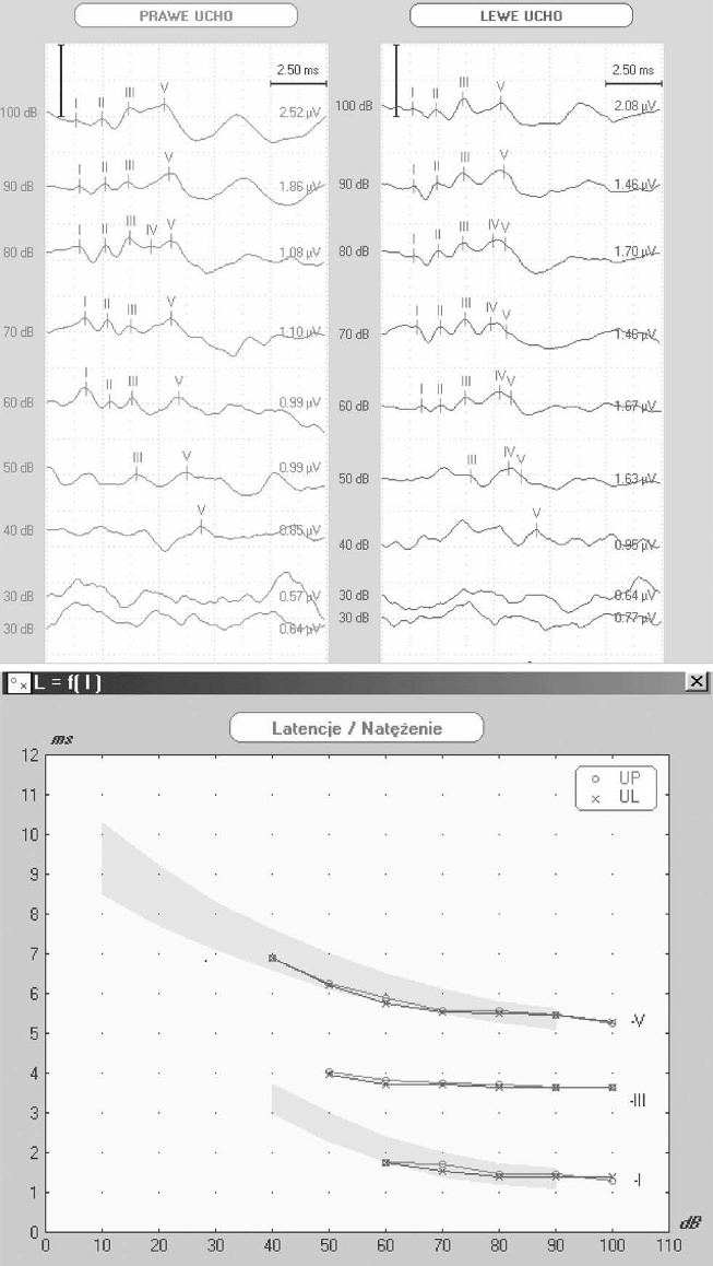 Ryc. 3. ABR 7 dzień po zatruciu CO OPIS PRZYPADKU Ryc. 4. Audiogram tonalny po 3 miesiącach (badanie kontrolne) Ryc.5.