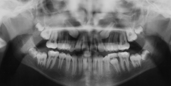 Zatrzymane kły szczęki w ortodontycznym ujęciu diagnostycznym przegląd piśmiennictwa Kąt P, zawarty pomiędzy długimi osiami bocznego siekacza i kła.