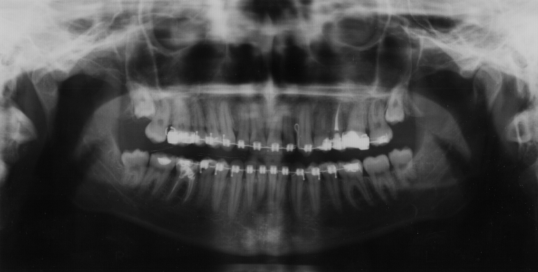 Pionizacja zęba 23 z przedsionkowym przemieszczeniem zęba i wprowadzeniem do łuku. Figure 4. Perpendicularly position 23 tooth with vestibularly motion and introduce to the arch.