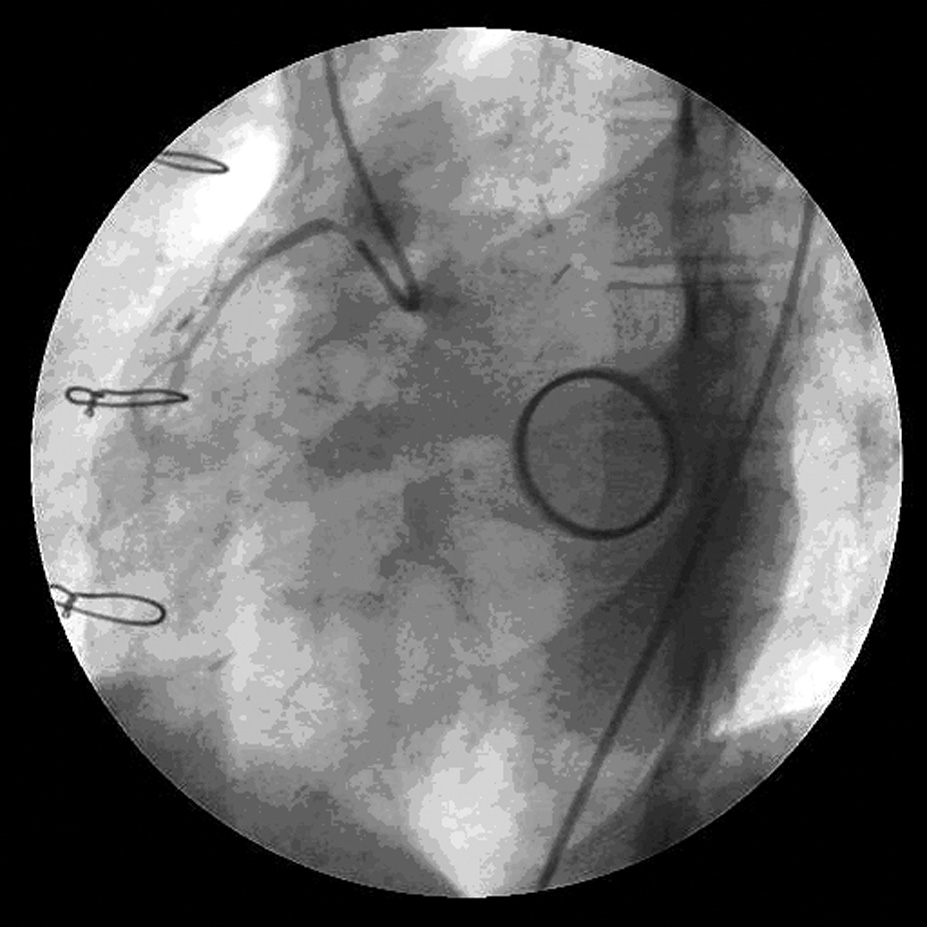 L. Markuszewski i wsp., ACS u chorej po MVR i AVR Rycina 3. Obraz angiograficzny prawej tętnicy wieńcowej przed implantacją stentu Figure 3.