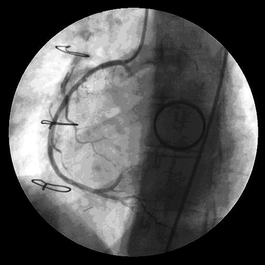 Angiographic view of right coronary artery after stent Cypher implantation implantacji zastawki mitralnej (MVR, mitral valve replacement) (pole średnicy 2,2 cm 2 ), śladową niedomykalność mitralną,
