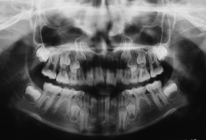 Tooth agenesis in the literature Prace przeglądowe / Reviews i radioterapia (5, 33, 34).