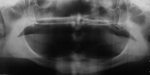 Tooth agenesis in the literature Prace przeglądowe / Reviews drugich zębów przedtrzonowych w żuchwie, górnych bocznych zębów siecznych, górnych drugich zębów przedtrzonowych oraz dolnych