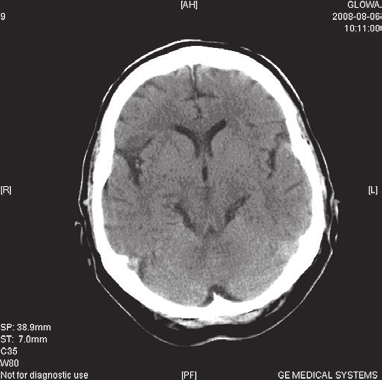 rt-p, po 2 godzinach wystąpił obustronny udar mózgu z zakresu unaczynienia tętnicy środkowej mózgu (MC, middle cerebral artery), a jednym z głównych objawów klinicznych był zespół wieczka przedniego.