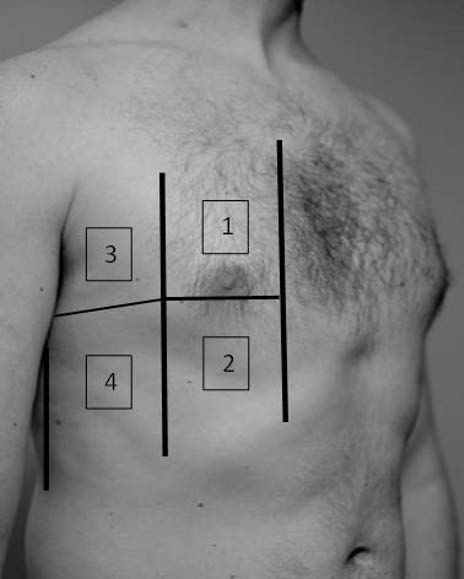 Pneumonologia i Alergologia Polska 2016, suplement I, strony A16 A24 Rycina 1. Podział klatki piersiowej na cztery strefy badania ultrasonograficznego po każdej ze stron, opracowany przez Volpicelli.