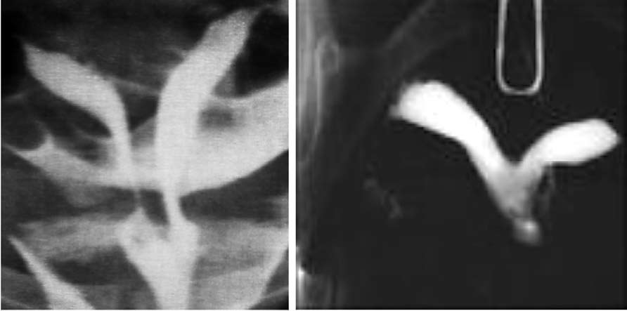 Wady wrodzone układu moczowo-płciowego u kobiet diagnostyka i postępowanie. Rycina 1. Kryteria różnicujące macicę dwurożną od macicy z przegrodą.