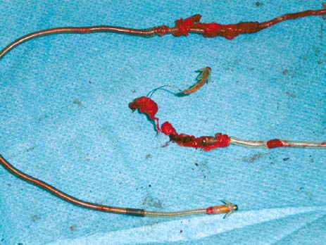 Folia Cardiologica Excerpta 2009, tom 4, nr 2 naprawcze typu opracowania rany, wycinania przetok i odleżyn oraz zbyt długa antybiotykoterapia nie są uzasadnione, zwiększają bowiem ryzyko wystąpienia