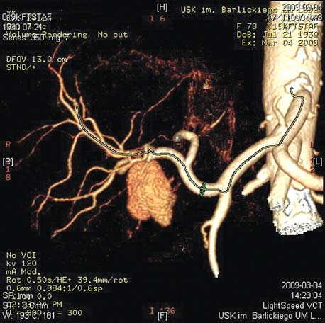US image of the liver hilum hypoechogenic lesion with hyperechogenic rim in colour technique, flow is visible in the lesion suggesting pseudoaneurysm Ryc. 2.