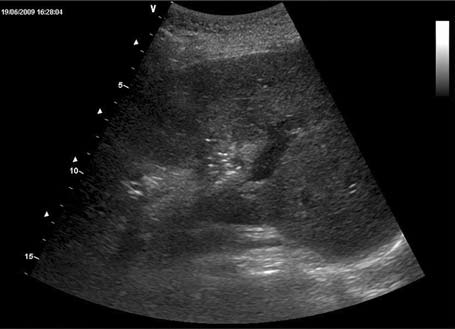 contrast-enhanced blood is able to fill the aneurysm sac zacji tętniaków tętnicy wątrobowej prawej z następczą rewizją endoskopową dróg żółciowych.