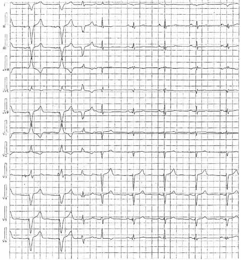 Dominika Pyszno-Prokopowicz et al. Table 1. Results of univariate analysis Variable Odds ratio 95% CI P Age 0.95 0.9 1.01 0.13 Male gender 0.7 0.2 3.5 0.7 Ischaemic cardiomyopathy 0.36 0.9 1.4 0.