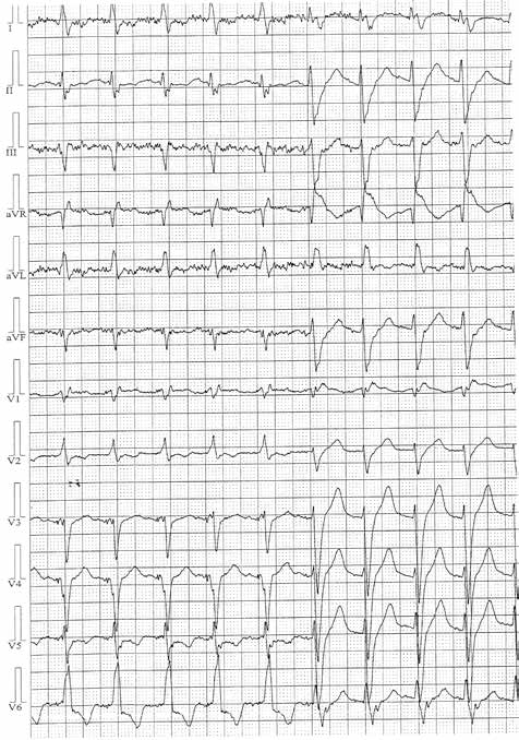 Analysis of the QRS morphology in lead V 1 during 24-hour Holter ECG monitoring DISCUSSION According to our knowledge, our study is the first to show potentially important benefits of routine 24-h