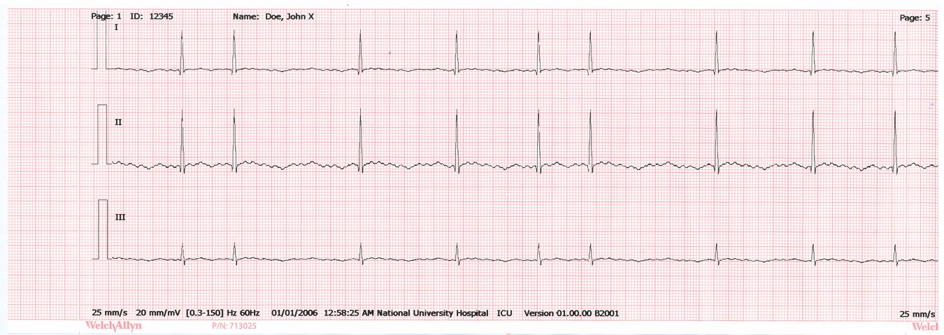 EKG można zapisywać w katalogu badań elektrokardiografu lub na urządzeniu magazynującym USB. W modelach CP 50 Plus Autom. EKG można także wysyłać do stacji roboczej Welch Allyn CardioPerfect.