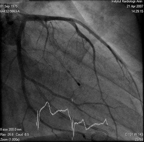 A B Ryc. 2. Obraz angiograficzny pocz¹tkowego odcinka ga³êzi przedniej zstêpuj¹cej chorego z kardiomiopati¹ przerostow¹ zawê aj¹c¹. A. Ocena têtnic przegrodowych przed zabiegiem. B. Weryfikacja lokalizacji balonika w ga³êzi przegrodowej.