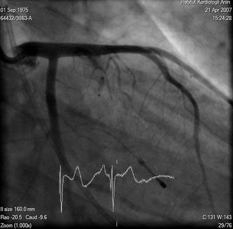 An over-the-wire 2.0 mm balloon positioned in the proximal part of the 1 st.