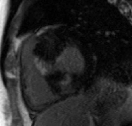 potwierdzaj¹, e zastosowanie tej metody leczenia powoduje obni enie gradientu w LVOT poprzez zmniejszenie gruboœci przypodstawnej czêœci przegrody, zmniejszenie SAM (ang.