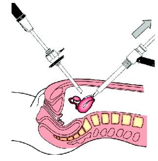 Morcelacja z tuleją ochronną Podczas histerektomii laparoskopowej morcelator umieszczany jest w jamie brzusznej wraz z obturatorem włożonym w tuleję ochronną.