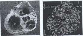 obrazie komór serca pozwala na określenie na przykład pojemności komór