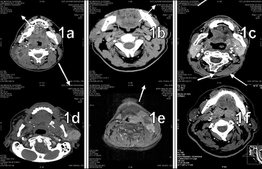 Wartość diagnostyczna wielorzędowej tomografii komputerowej i rezonansu magnetycznego w diagnostyce głęboko położonych guzów... Ryc. 1. a. TK z kontrastem i.v.