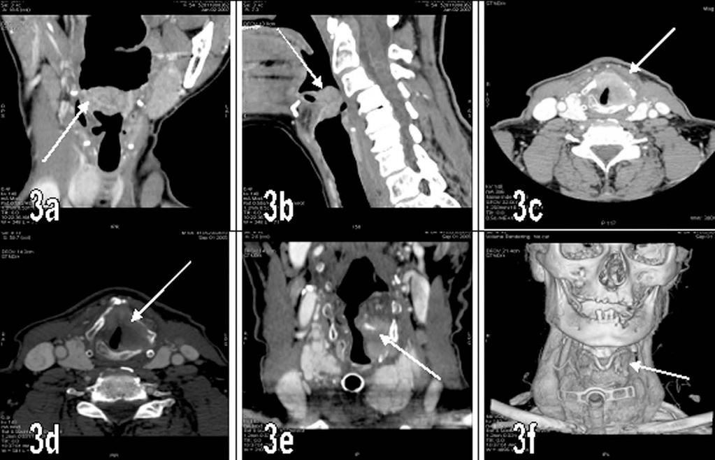 Wartość diagnostyczna wielorzędowej tomografii komputerowej i rezonansu magnetycznego w diagnostyce głęboko położonych guzów... Ryc. 3. (a, b) TK z kontrastem i.v.