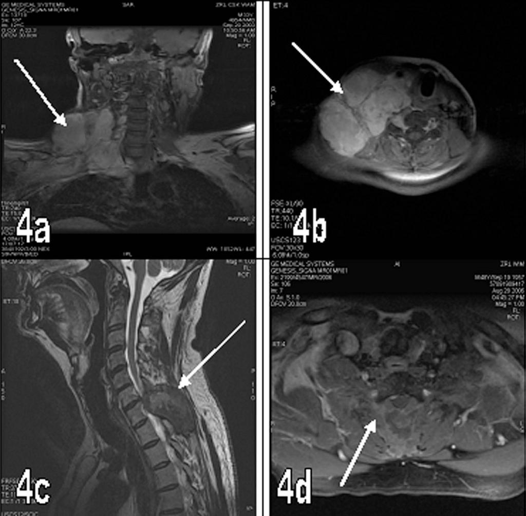 us al on pe rs for y is Ryc. 4. (a, b). MR z kontrastem i.v. Obrazy T1zależne. Masa guzowata szyi po stronie prawej obmurowująca przestrzeń okołokręgosłupową. Neurofibromatoza typ I. (c, d).